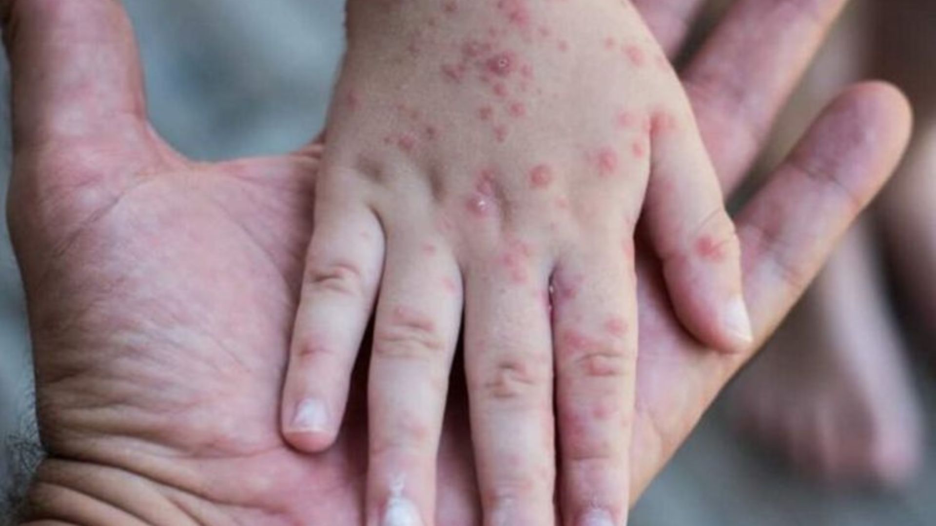 Viral Kasus Mpox, Yaitu Penyakit Ringan Namun Bisa Membunuh